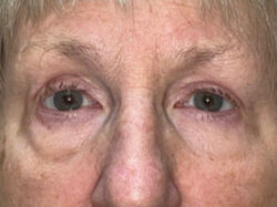 Eyelid Lift (blepharoplasty/ptosis repair)