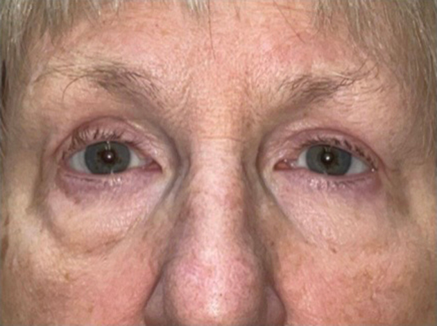 Eyelid Lift (blepharoplasty/ptosis repair)