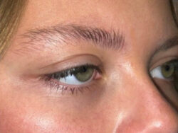 Eyelid Lift (blepharoplasty/ptosis repair)