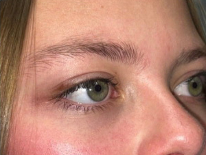 Eyelid Lift (blepharoplasty/ptosis repair)