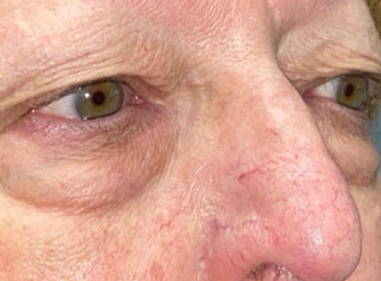 Upper/Lower Lid Blepharoplasty