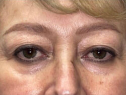 Upper Lid Blepharoplasty (upper eyelid lift)