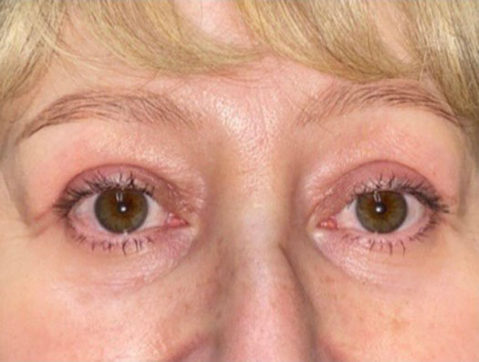 Upper Lid Blepharoplasty (upper eyelid lift)