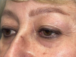 Upper Lid Blepharoplasty (upper eyelid lift)