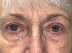 Eyelid Lift (blepharoplasty/ptosis repair)