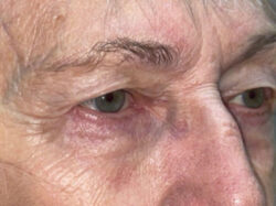 Eyelid Lift (blepharoplasty/ptosis repair)