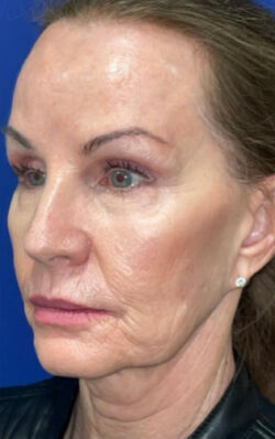 Face/Neck Lift