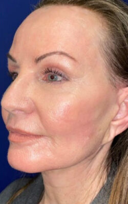 Face/Neck Lift