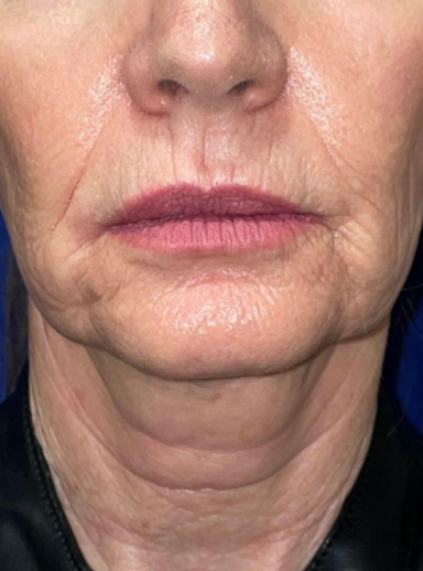 Face/Neck Lift