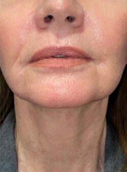 Face/Neck Lift