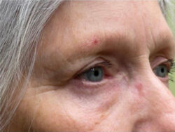 Upper/Lower Lid Blepharoplasty