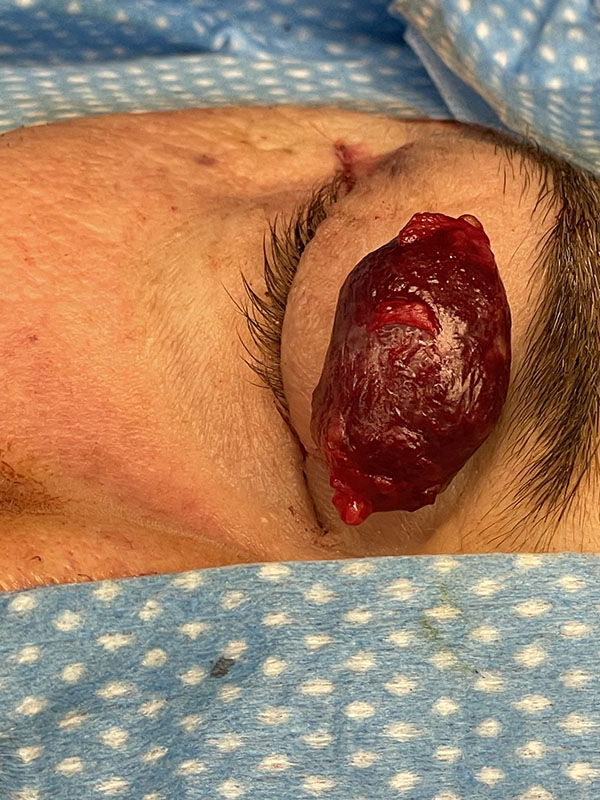 Tumors 2 Benign Cavernous Hemangioma extracted from behind a patients eye