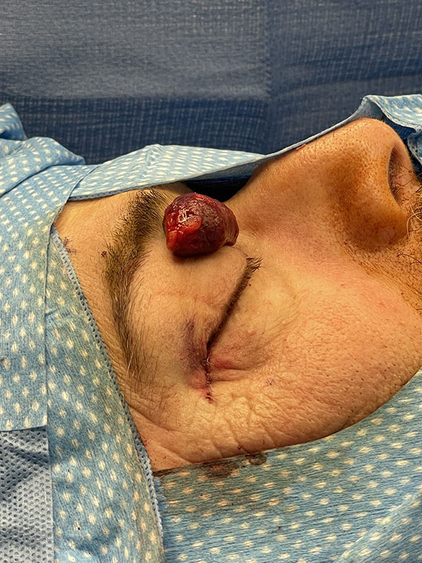 Tumors 1 Benign Cavernous Hemangioma extracted from behind a patients eye2