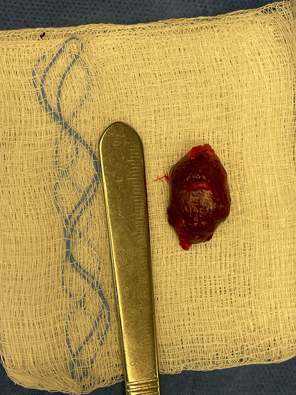 Tumors 3 Benign Cavernous Hemangioma extracted from behind a patients eye3