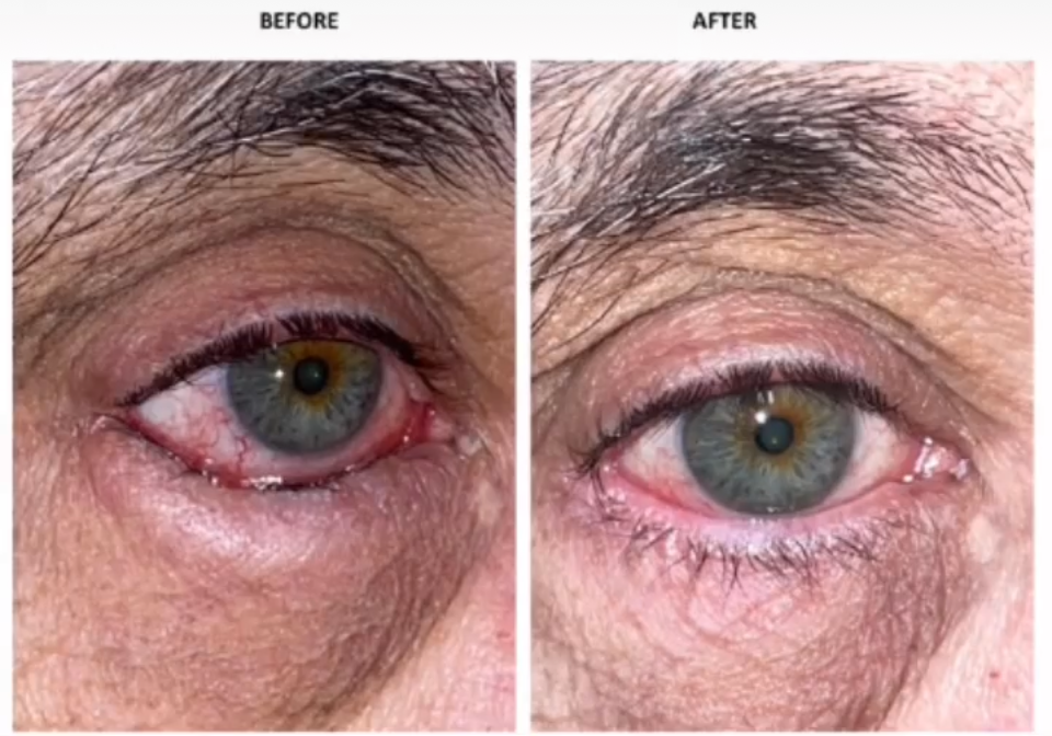 Entropion before after