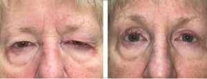 Before and after comparison of upper eyelid lift in older patient