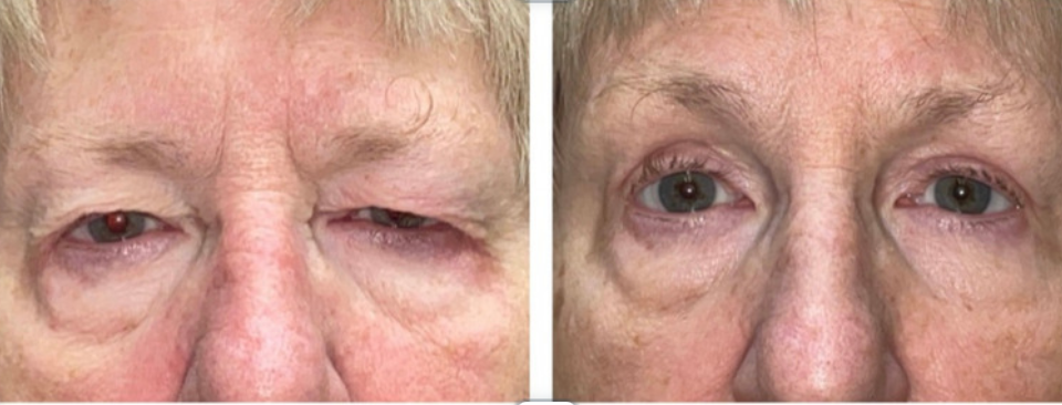 eyelid laxity before after