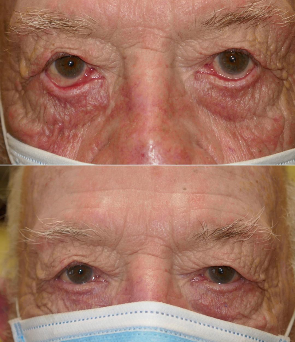 idaho eyelid ectropion