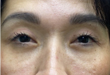 Upper/Lower Lid Blepharoplasty