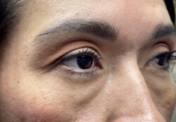 Upper/Lower Lid Blepharoplasty