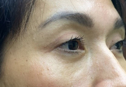 Upper/Lower Lid Blepharoplasty