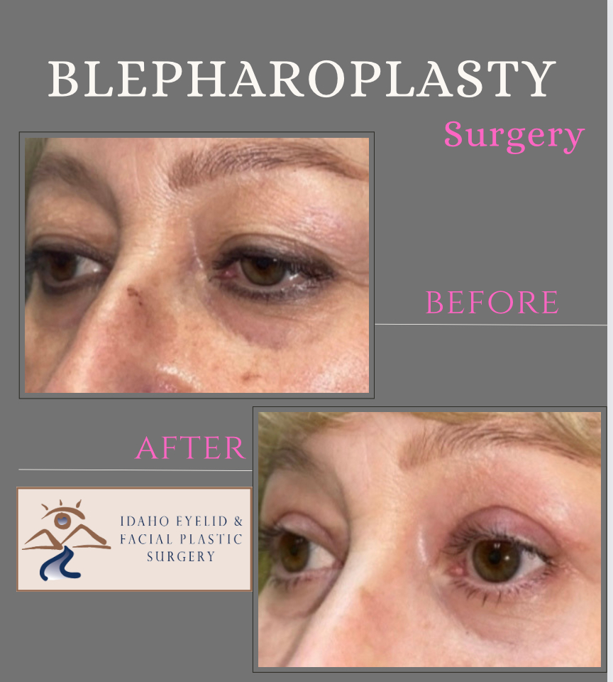 Blepharoplasty before and after photo