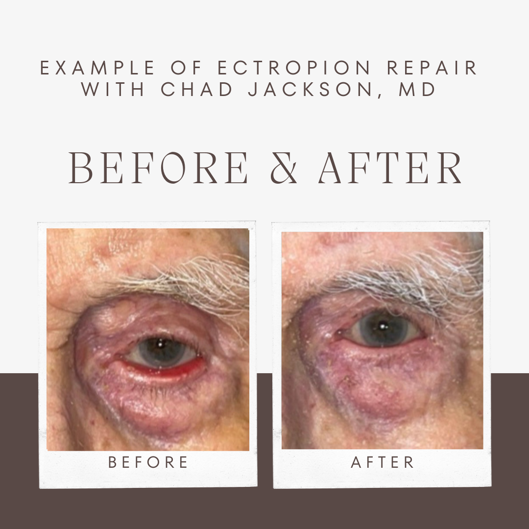 Ectropion Repair before and after photo