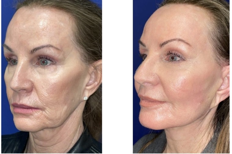 Facelift before and after photo