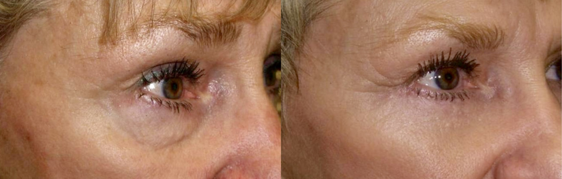 Fat Transfers before and after photo