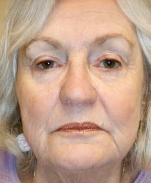 Laser Resurfacing 2 Laser Resurfacing After Photo
