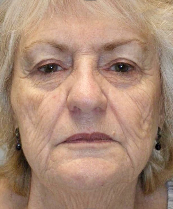 Laser Resurfacing 1 Laser Resurfacing