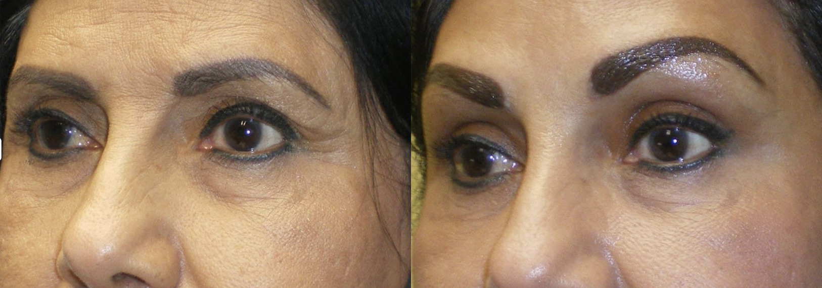Services 7 forehead lift before and after
