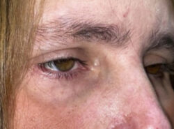 Eyelid Lift (blepharoplasty/ptosis repair)