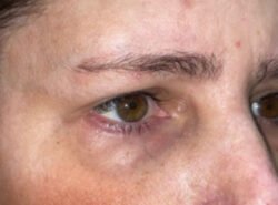 Eyelid Lift (blepharoplasty/ptosis repair)