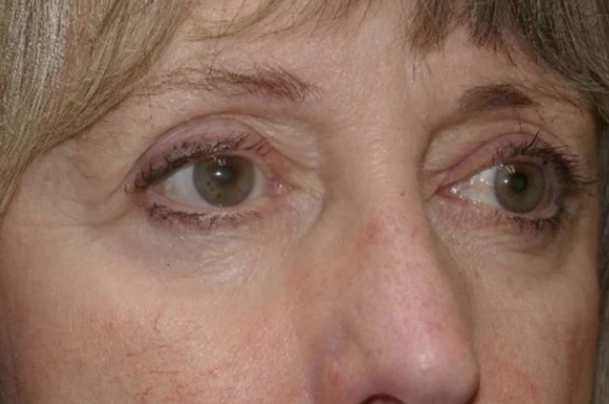 Lower Lid Blepharoplasty (lower eyelid eyelift)
