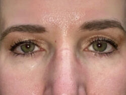 Combination Surgeries (eyelid lift and other)