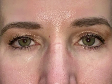 Combination Surgeries (eyelid lift and other)