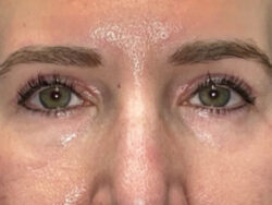 Combination Surgeries (eyelid lift and other)