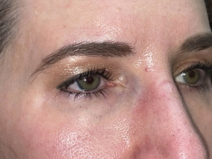 Combination Surgeries (eyelid lift and other)