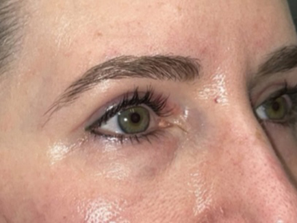 Combination Surgeries (eyelid lift and other)