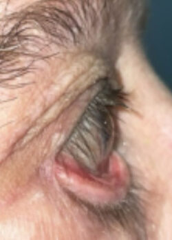Ectropion, Entropion (Repair of Lower Lid Malposition)