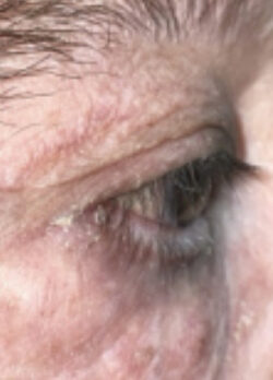 Ectropion, Entropion (Repair of Lower Lid Malposition)