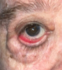 Ectropion, Entropion (Repair of Lower Lid Malposition)