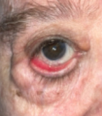 Ectropion, Entropion (Repair of Lower Lid Malposition)