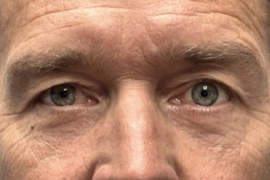 Lower Lid Blepharoplasty (lower eyelid eyelift)