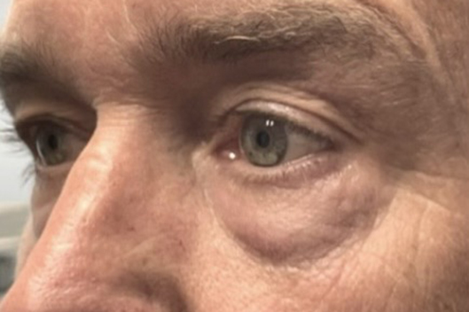 Lower Lid Blepharoplasty (lower eyelid eyelift)