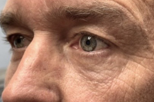 Lower Lid Blepharoplasty (lower eyelid eyelift)