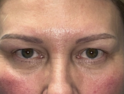 Upper Lid Blepharoplasty (upper eyelid lift)
