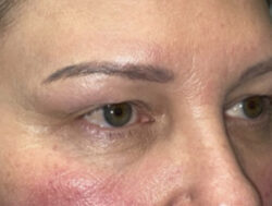 Upper Lid Blepharoplasty (upper eyelid lift)