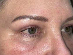 Upper Lid Blepharoplasty (upper eyelid lift)
